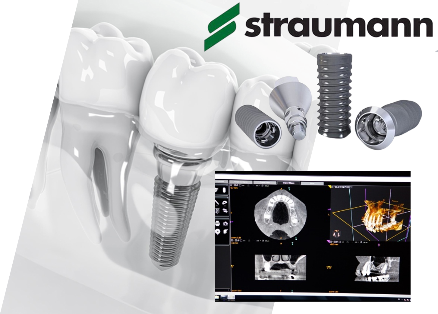 長久手フラワー歯科 口腔外科・矯正歯科のインプラント