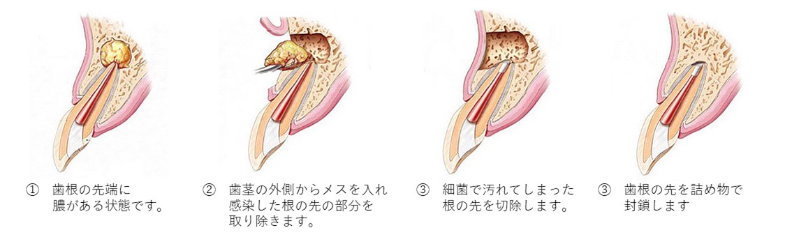 長久手市の歯医者、長久手フラワー歯科の根管治療