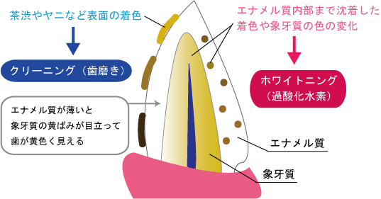 長久手市の歯医者、長久手フラワー歯科のホワイトニング